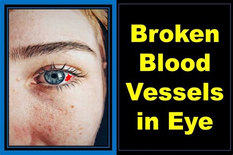 blood leaking from eye|Popped Blood Vessel in Eye: Causes, Treatment,。